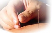 Practical Dry Needling Level One - Integrating Cervical, Lumbar, Extremities, Fascia, Scar and Tendon